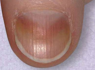 指甲上的小白点,到底是缺锌,缺钙还是有蛔虫?