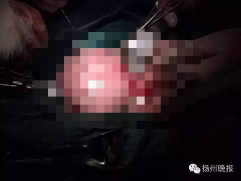 17岁女孩闭经5月肚子大了 医生手术取出长发怪物