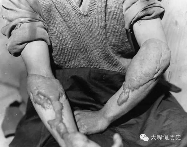 广岛原子弹爆炸的受害者,展示他被烧伤的胳膊.