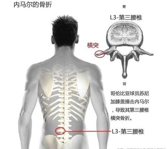 经过x光检查,内马尔被确诊为第三腰椎横突骨裂,将缺席本届杯赛余下的