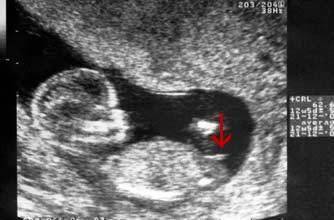 小肿块以一个陡峭的角度向上指,显示这个胎儿是个男孩.