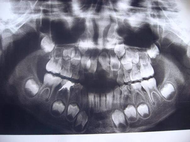 宝宝换牙期牙齿排列是什么样子?几张图一目了然