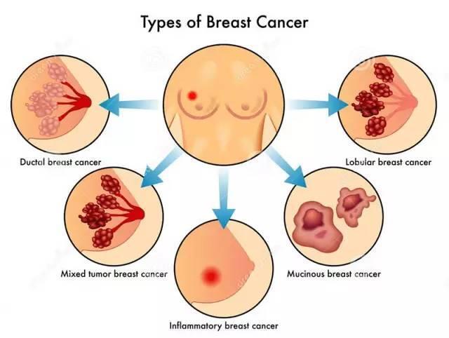 乳腺癌早期的7大症状乳腺癌的8大诱因