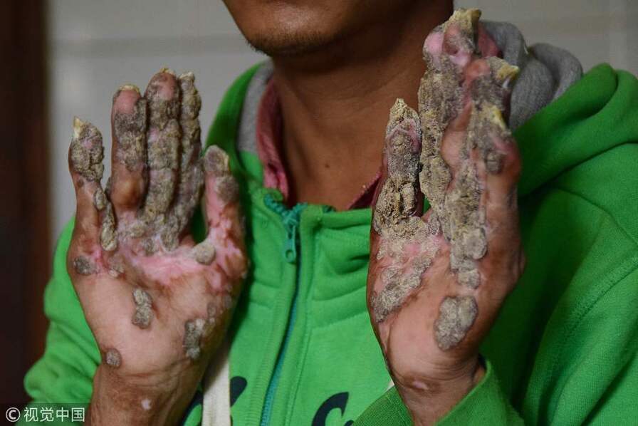 孟加拉国达卡,"树人"abul bajandar的手上又长出了疣