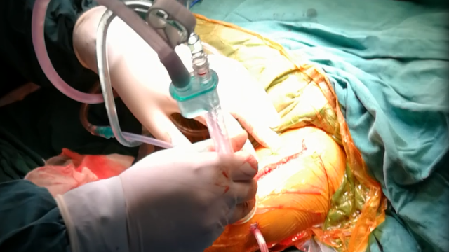 一次性脉冲冲洗器的使用方法