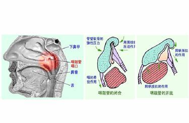 咽鼓管异常开放