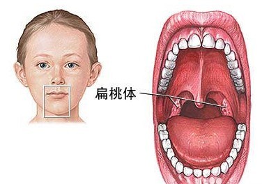 青少年急性扁桃体炎症状