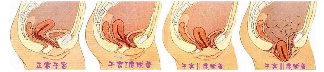 轻一点的是子宫颈下垂到荫 道口,重一点是子宫颈露出荫 道口外,甚至