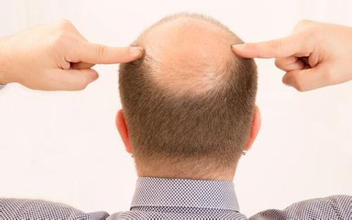 你知道吗?毛囊闭合后想生发就难了!