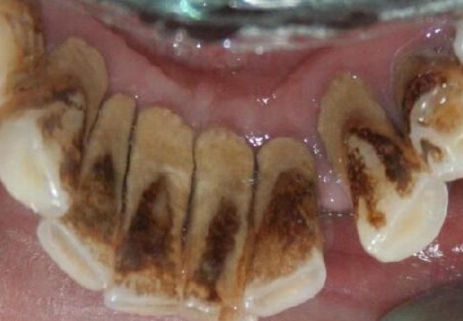 医生,男朋友有牙周炎,接吻会传染给我吗?