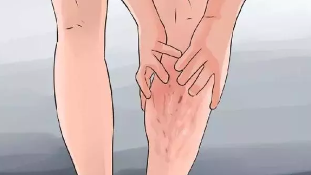 小腿经常发痒，警惕静脉曲张！