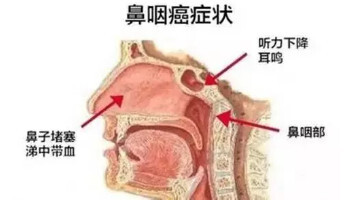 鼻咽癌离我们远吗?这些早期症状你一定不要忽视__凤凰网