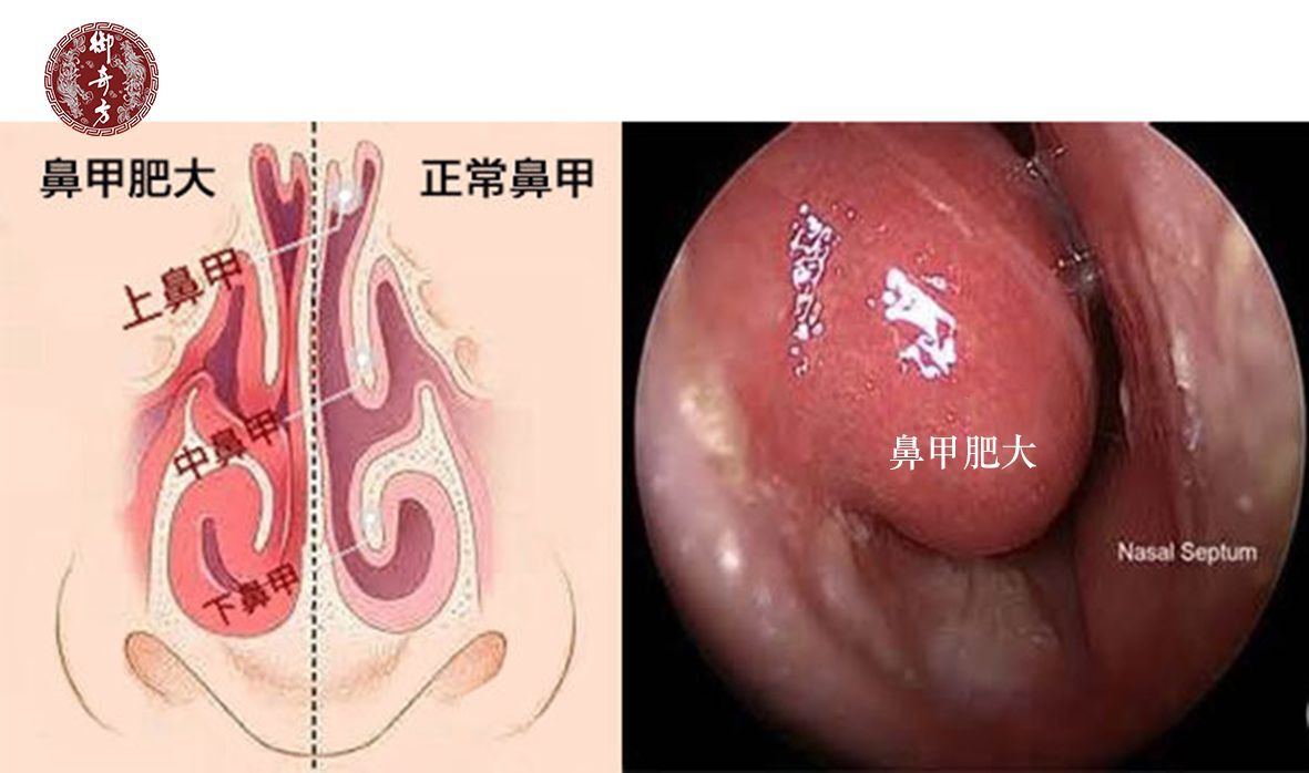 鼻甲肥大的危害