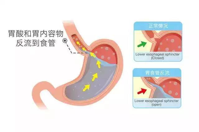 医生解释,一方面胃内食物和胃酸反流到食管,刺激心脏和食管共同的