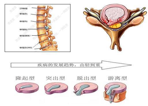 按摩治疗腰间盘突出是什么原理(3)