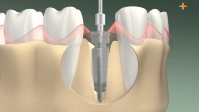 单颗种植牙多少钱，视频告诉你钱花在哪