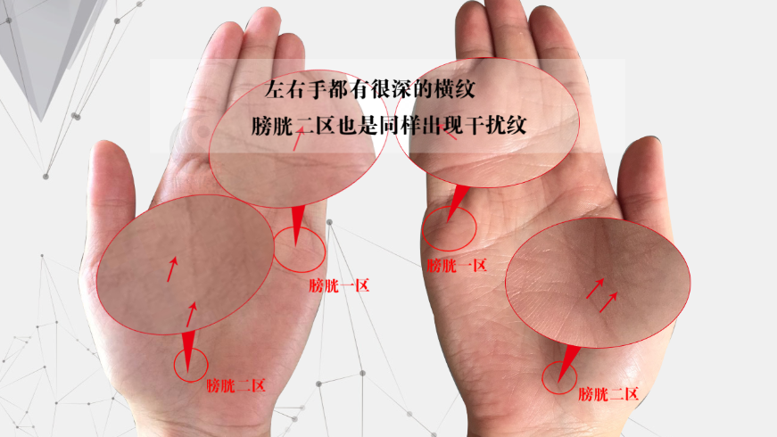 3分钟 教你学会看肾的手纹与反映出来的疾病 掌纹分析顾客(1)__凤凰网