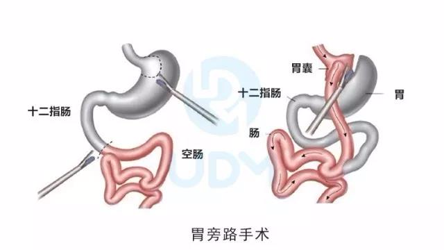 胃旁路手术原理