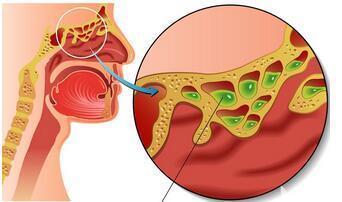 领募:鼻窦炎的发病原因有哪些?