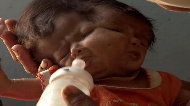 印度妇女产下双面女孩，被村民奉为转世灵童，却在随后发生悲剧