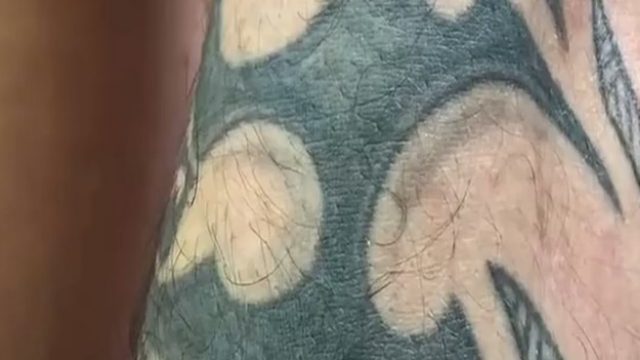 洗纹身有多疼？激光一点点打在胳膊上，一看再也不想去纹身了！