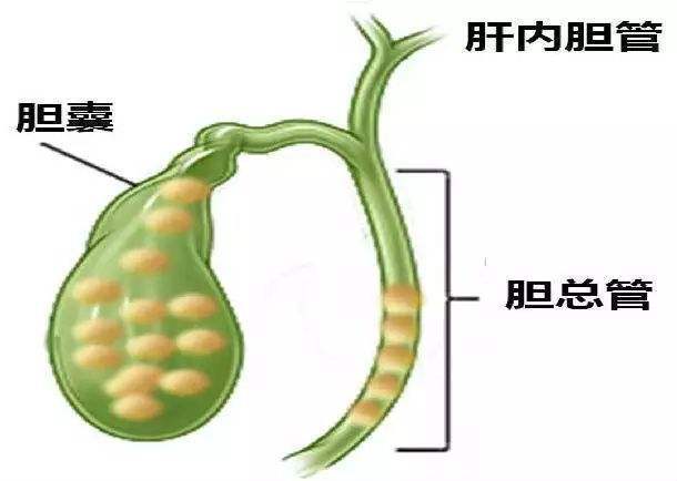 治疗胆结石最常见方式为药物治疗和微创手术,保胆手术