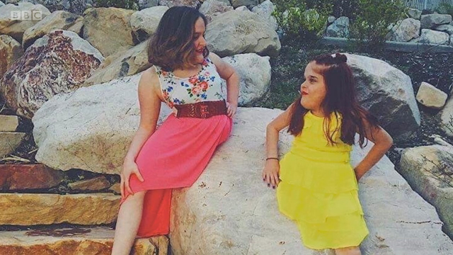 连体双胞胎姐妹：不同一般的生活[英字]