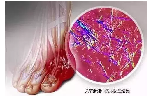 说明尿酸盐结晶已经在身体的不同位置堆积了,痛风病情在加重,需要引起