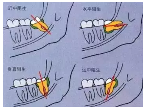 阻生智齿的几种常见类型 口说无凭,上病例.来看下面这例