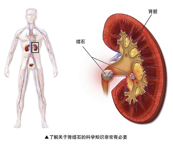 生活中预防肾结石复发要做好这几个方面,能有效防治肾结石!__凤凰网