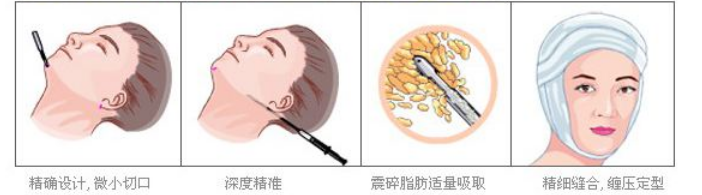 吸脂手术对改善因脂肪丰厚而形成的肢体臃肿也有显著的效果,很适合双