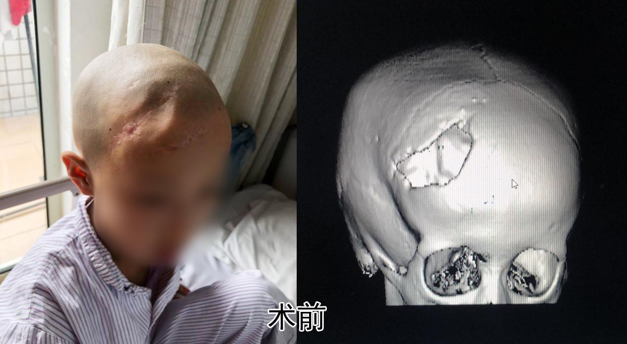 上舞蹈班的途中遭遇车祸,就诊于当地医院,行头颅ct提示右额叶脑挫裂伤