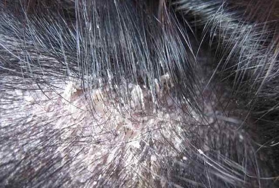 为什么毛囊炎会引起脱发?