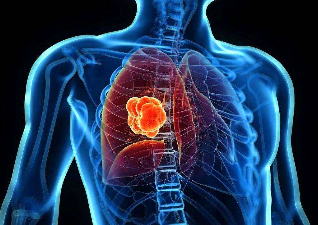 肺癌和普通的肩周炎疼痛虽然很容易混淆,但两者还是可以区分的,长沙市