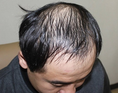 脂溢性脱发还会长吗？有什么好的办法吗？__凤凰网