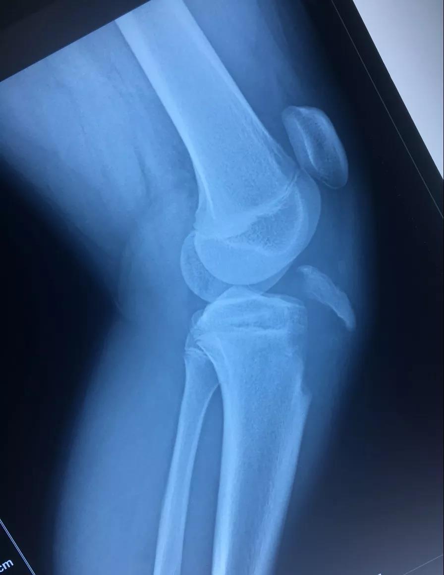 位于膝关节前方的骨折片便是撕脱下来的胫骨结节骨骺.