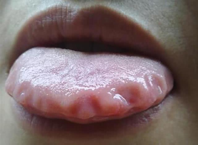 经常舌头发麻怎么回事中医警惕三种危险疾病易导致舌头发麻