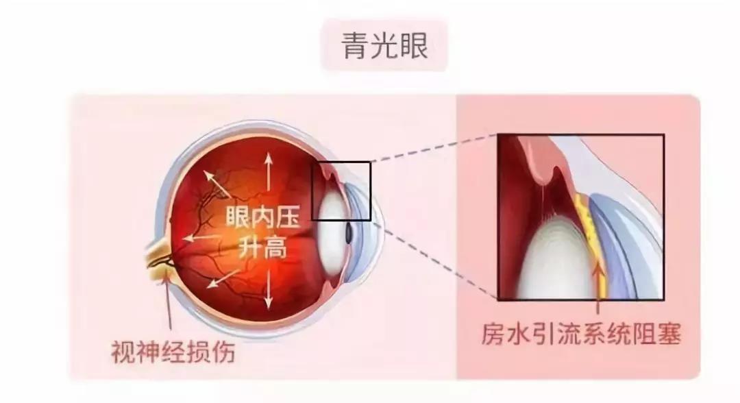 激素性青光眼早期较为隐秘,没有明显症状,中晚期才感觉有轻微头痛,眼