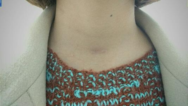 你知道吗？用这种方法切除甲状腺脖子上不留疤