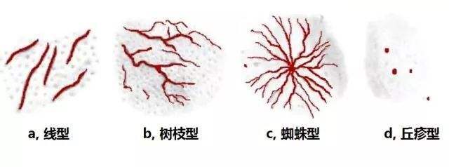 罗在德介绍毛细血管扩张有哪些危害