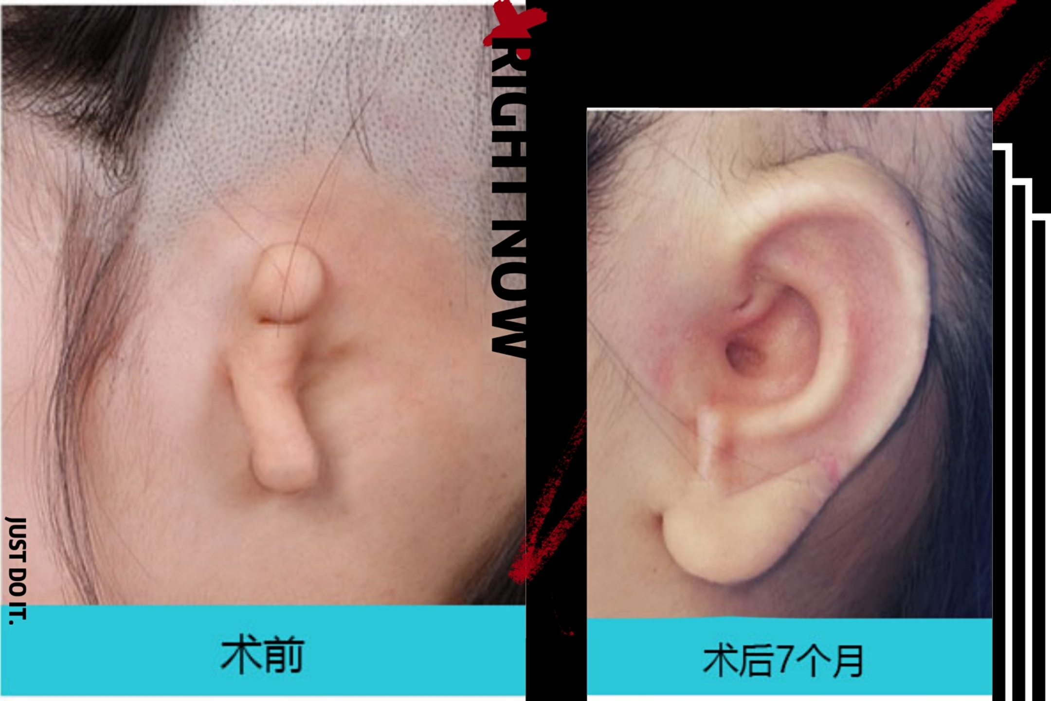 【耳廓畸形】几种常用的修复方法