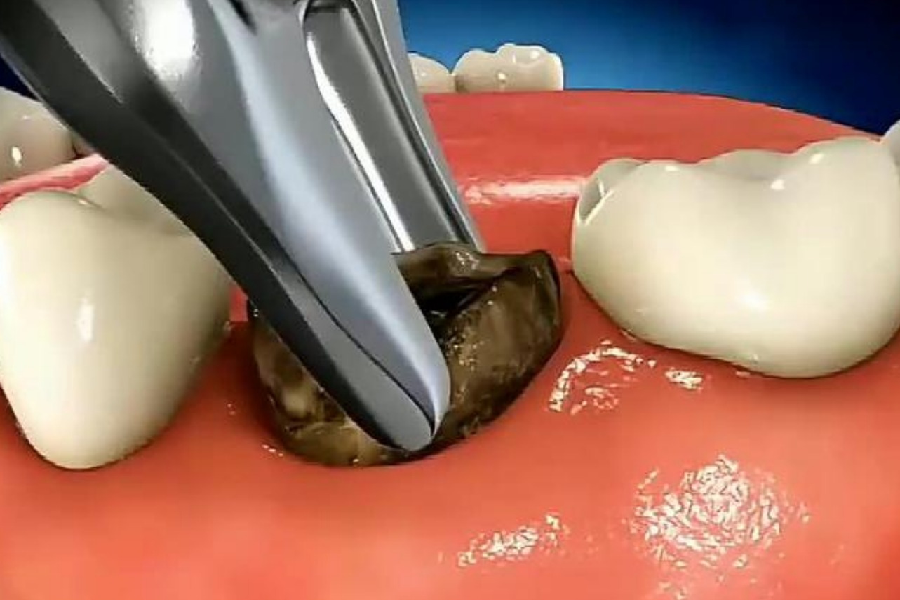 拔牙竟然这么可怕，3D还原全过程，怪不得那么疼！
