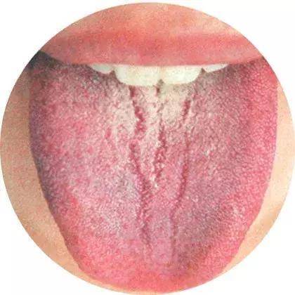 慢性舌炎有什么具体症状呢