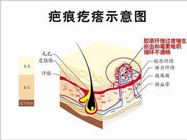 罗在德医生讲解疤痕疙瘩跟遗传有关系吗?__凤凰网