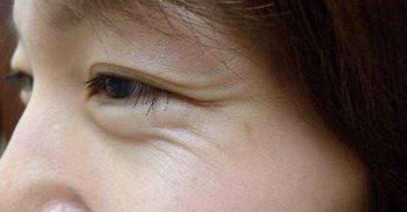 40岁眼部保养重点:消除脂肪粒淡化皱纹