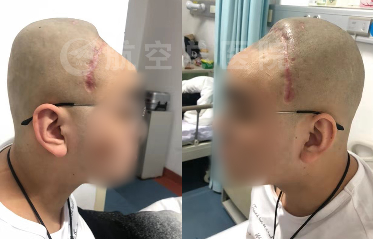 修补好颅骨再出发18岁准大学生开启新的人生旅程