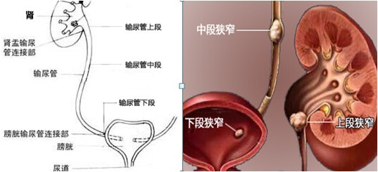 肾结石吃什么有利于自然排出?这4种自然排出法很有效!