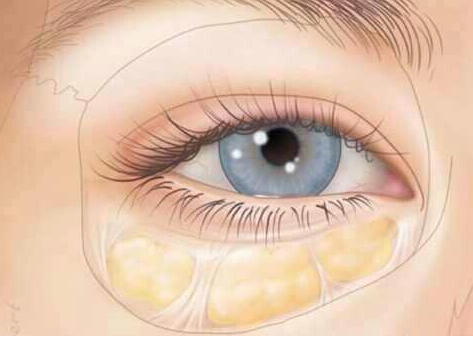外切去眼袋后有皱纹怎么回事,外切去眼袋会有风险吗?