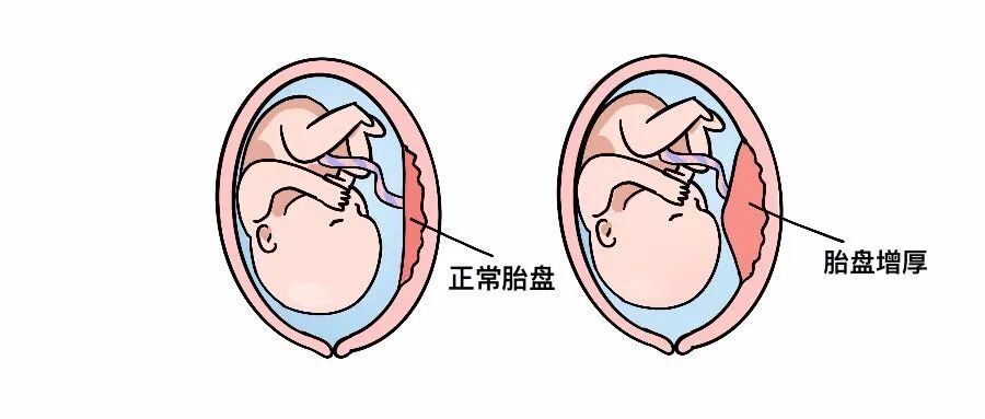 胎盘增厚是代表着胎盘早剥了吗