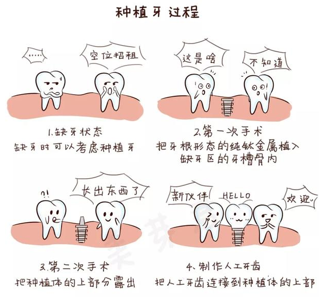健康牙齿的话,传统假牙是无法进行修复缺牙的,此时就需要种植牙来解决